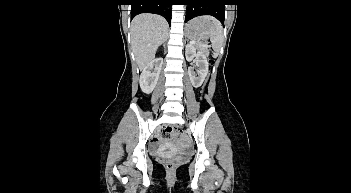 Adrenal Myelolipoma 1