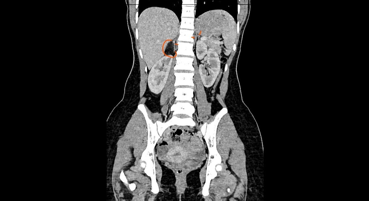 Adrenal Myelolipoma 2