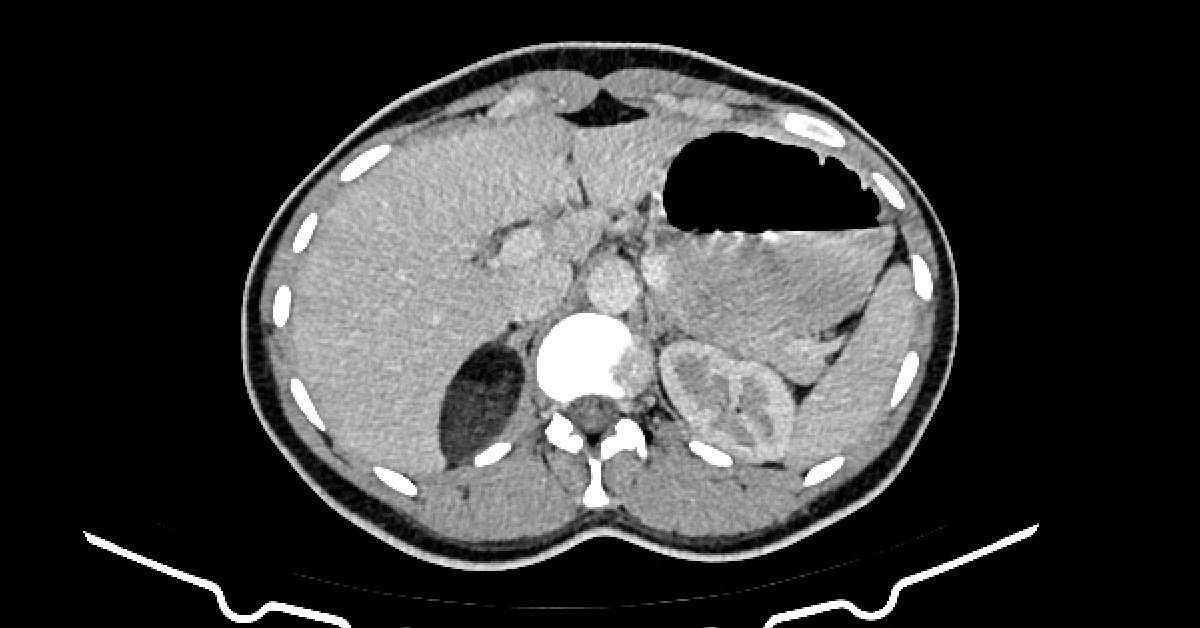 Adrenal Myelolipoma 3