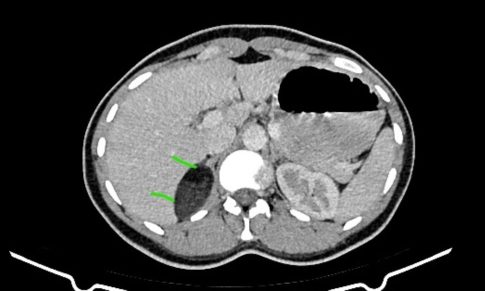 Adrenal Myelolipoma