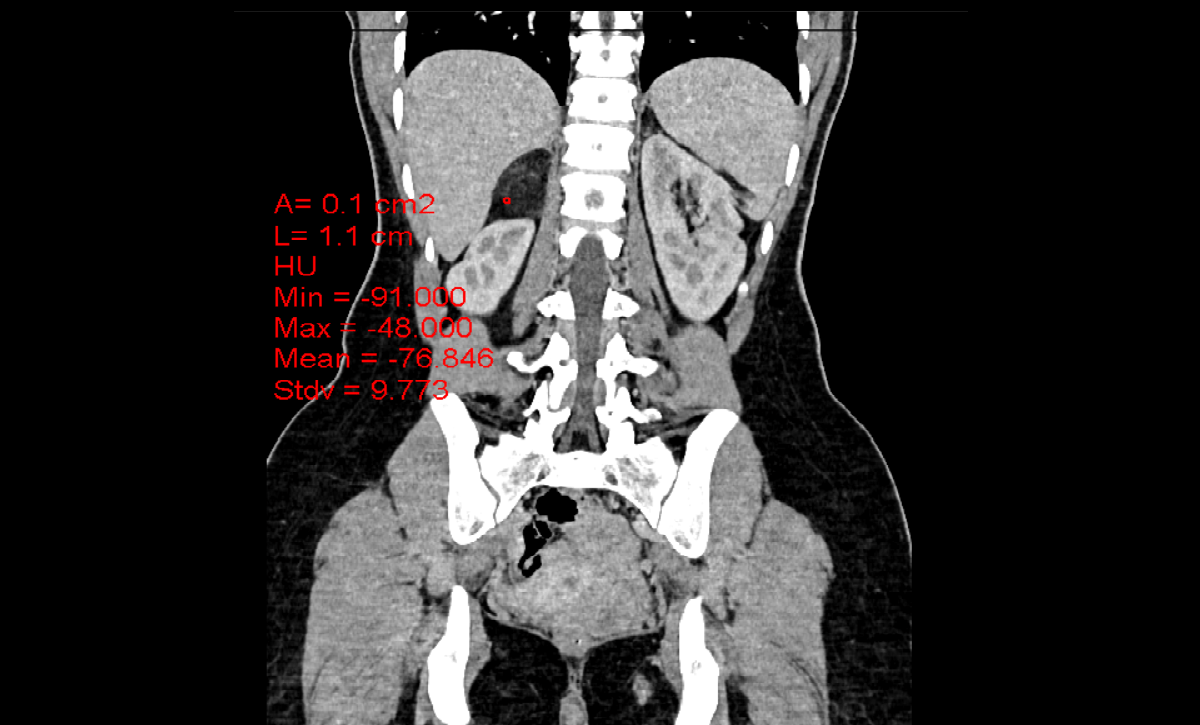 Adrenal Myelolipoma 5