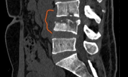 Lumbar Spondylodiscitis