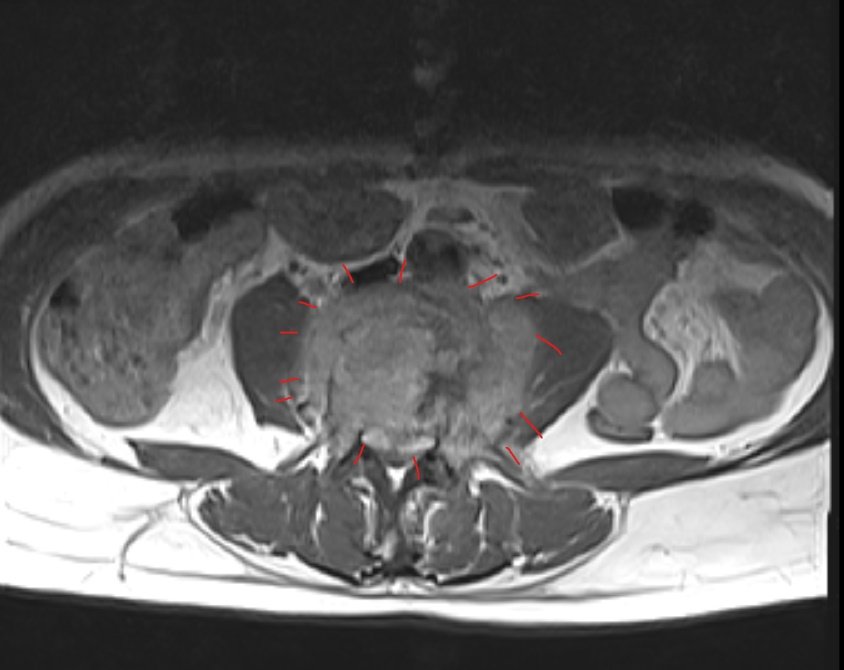Lumbar Spondylodiscitis 6