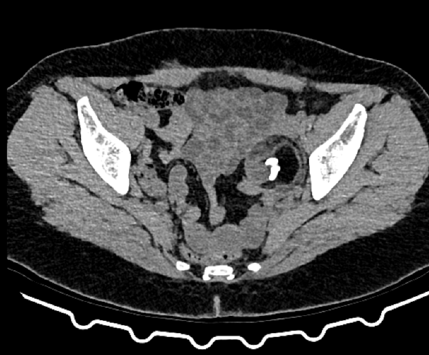 Mature cystic teratioma (1)