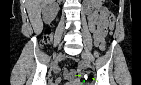 Adnexal Mature Cystic Teratoma (Dermoid Cyst).