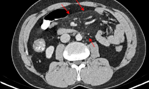 Mesenteric Panniculitis