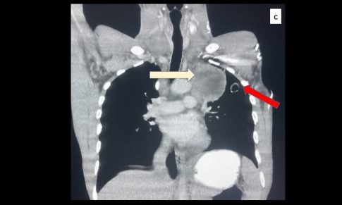 Primary Pulmonary Hodgkin Lymphoma