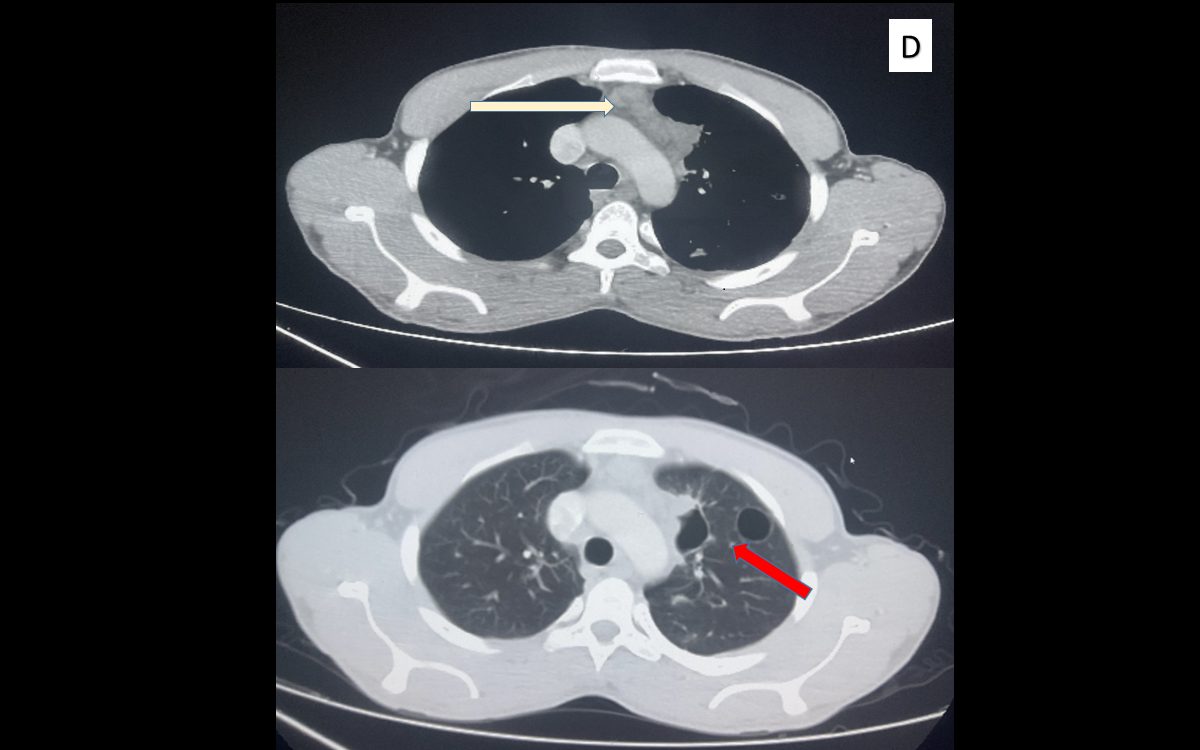 Primary Pulmonary Hodgkin Lymphoma D