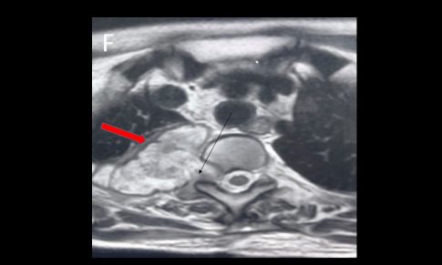 Synovial Sarcoma of Cervical Spinal Nerves