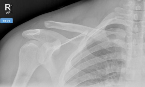 Acromioclavicular (AC) joint dislocation