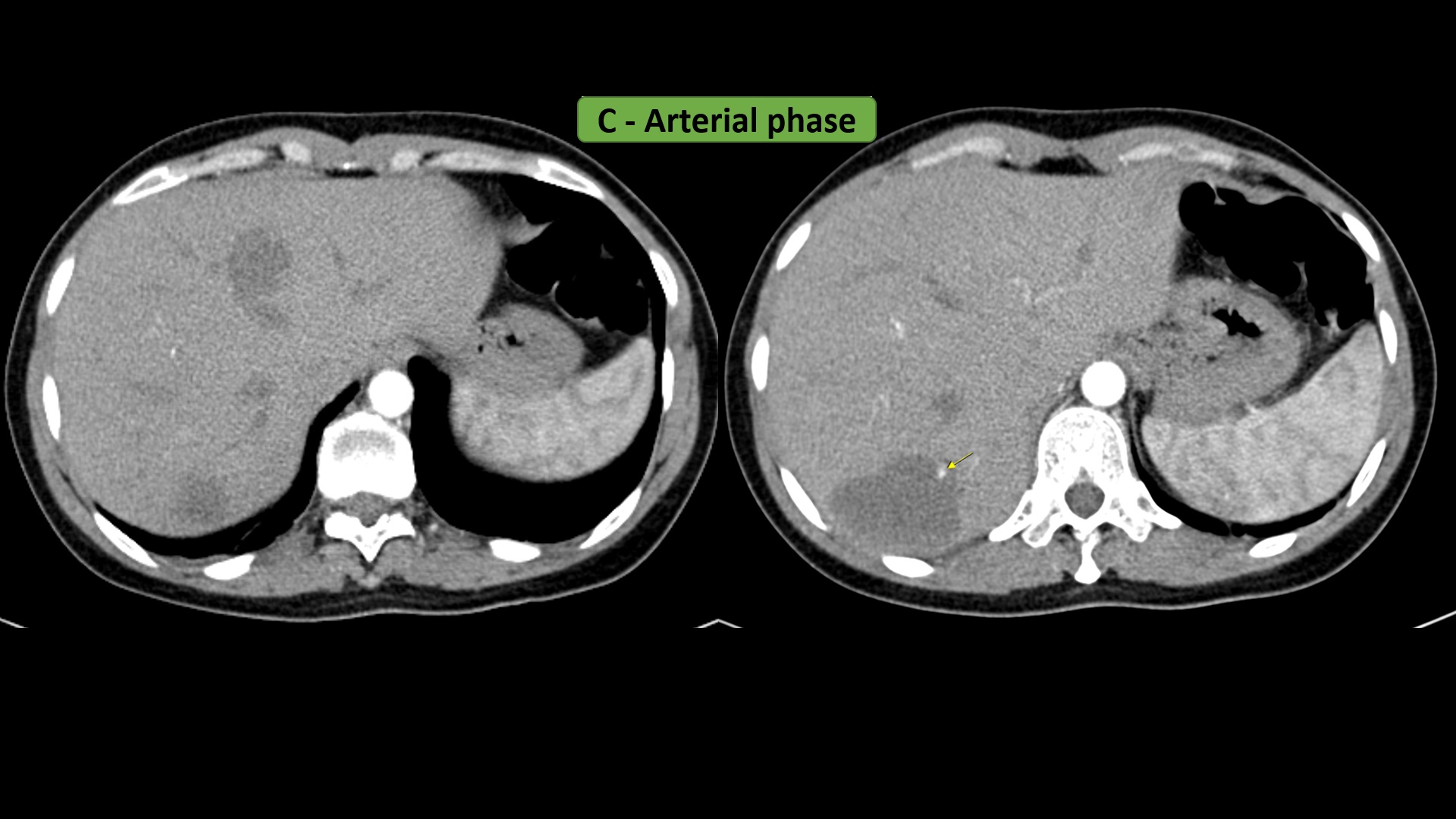 Hepatic hemangioma C1