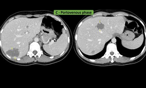 Hepatic Hemangiomas