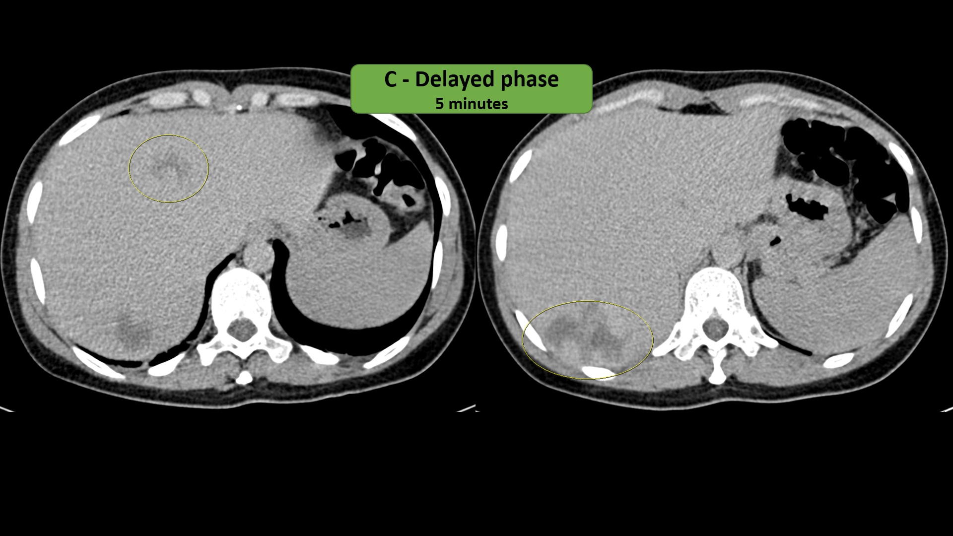 Hepatic hemangioma C5