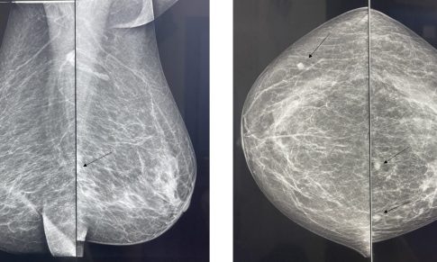Occult breast cancer