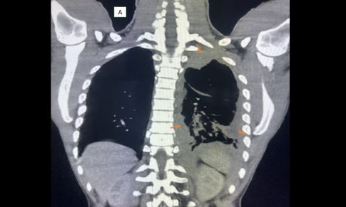 Pleural T-Cell Lymphoma
