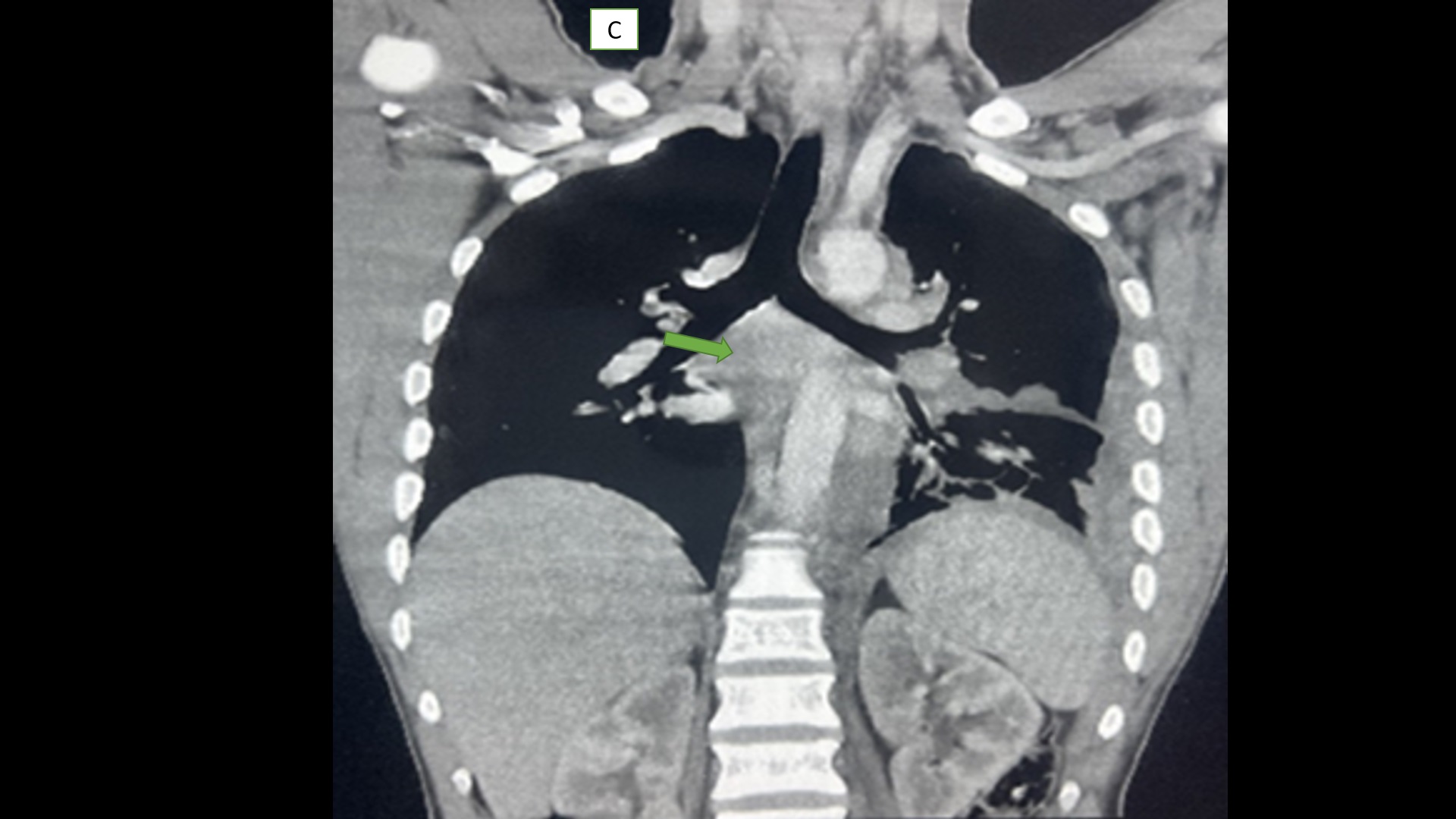 Pleural T-Cell Lymphoma C