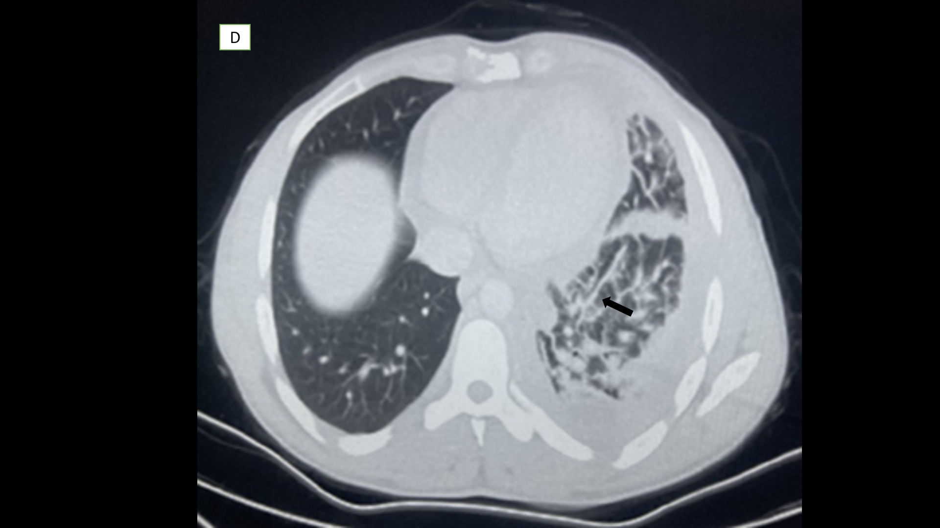 Pleural T-Cell Lymphoma D